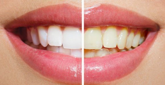 Clareamento Dental – Tudo o que precisa de saber
