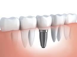 Tudo sobre Implantes Dentários