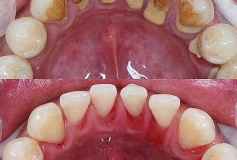 Como evitar o tártaro nos dentes?