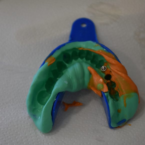 Moldes Dentários – Para que serve?