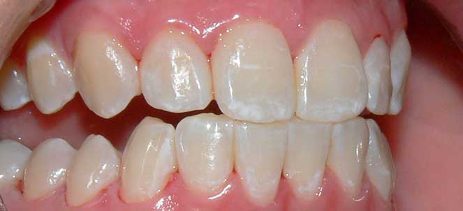 Tudo sobre fluorose dentária