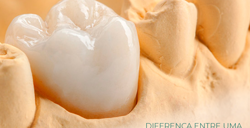 Diferença entre Coroas sobre Implantes e Coroas sobre dente natural