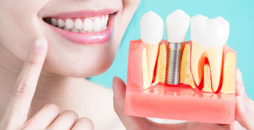 5 etapas para quem decidiu investir num implante dentário