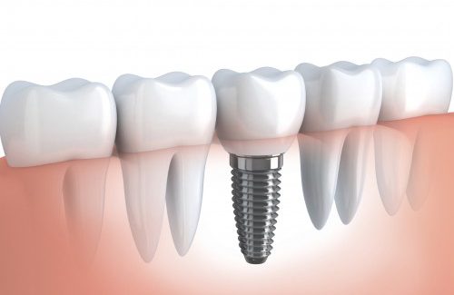 Guia sobre Implantes Dentários
