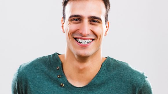 5 vantagens para usar aparelho dentário