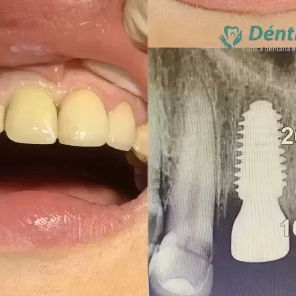 Próteses sobre implantes