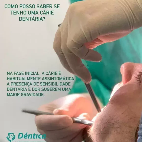 Como posso saber se tenho uma cárie dentária?