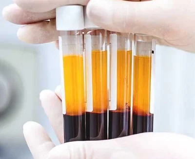 Plasma PRP em medicina dentária