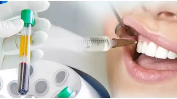 PRP-плазма в стоматологии