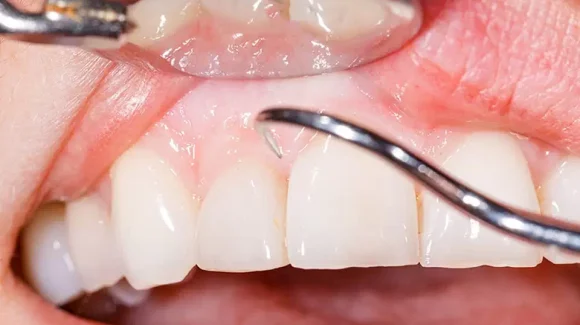 Пародонтит