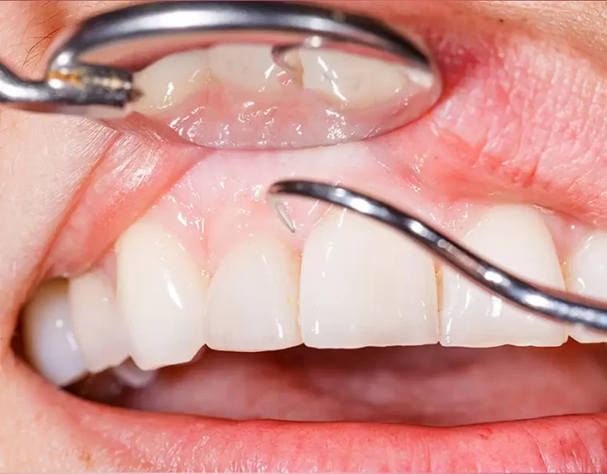 Пародонтит