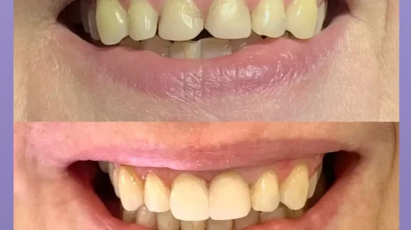 Эстетическая реставрация передних зубов