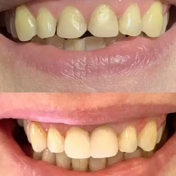 Эстетическая реставрация передних зубов