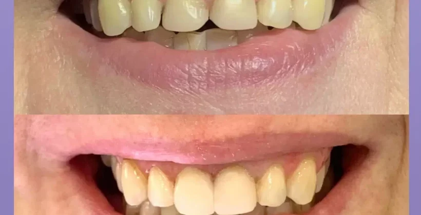 Эстетическая реставрация передних зубов