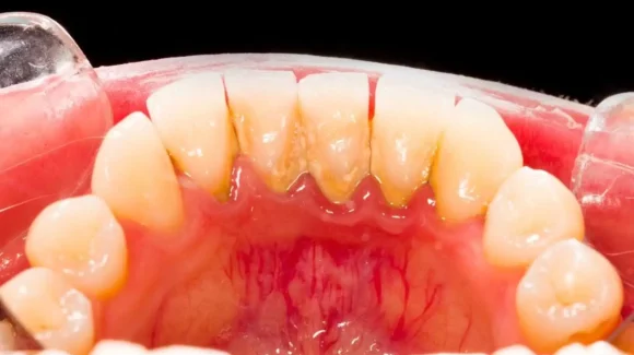 Воспаление пародонта