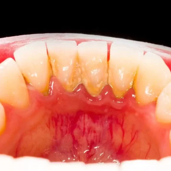 Воспаление пародонта