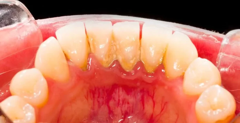 Воспаление пародонта