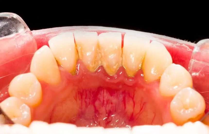 Воспаление пародонта Воспаление пародонта