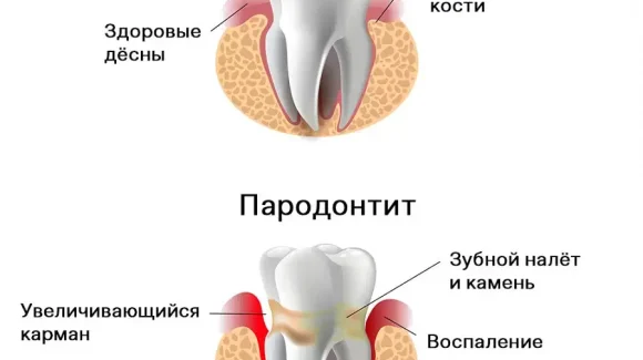 Пародонтит