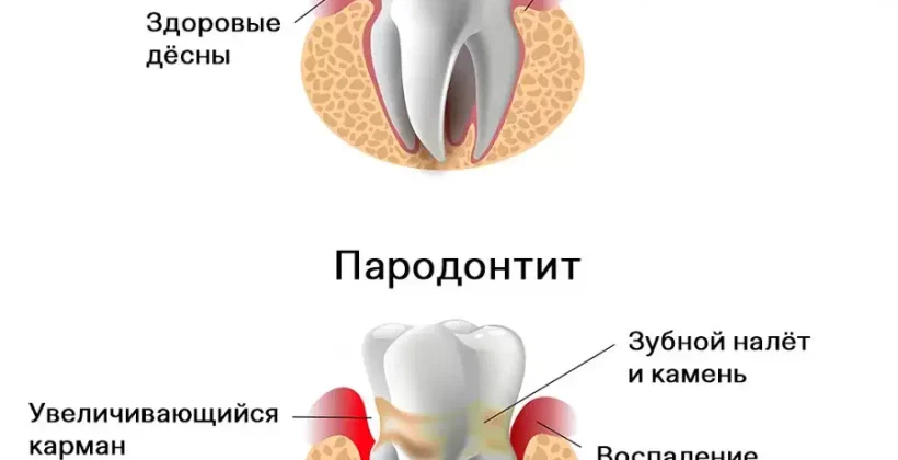 Пародонтит