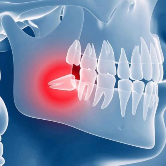 Зубы мудрости
