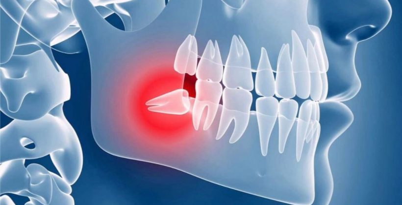 Зубы мудрости