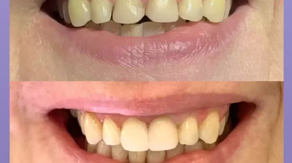 Restauração estética de dentes anteriores
