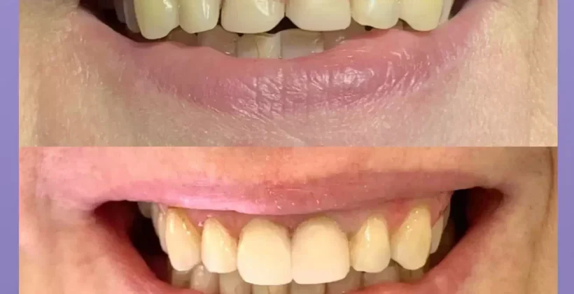 Restauração estética de dentes anteriores