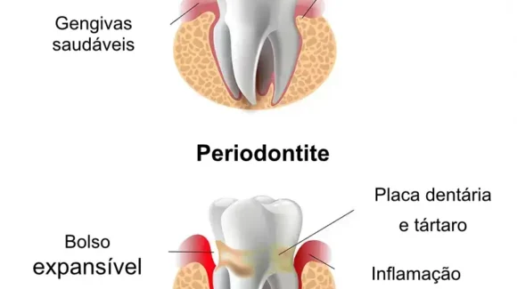 Periodontite