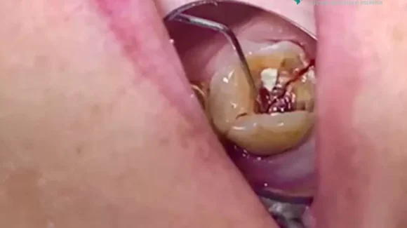 Quando um dente se parte em dois