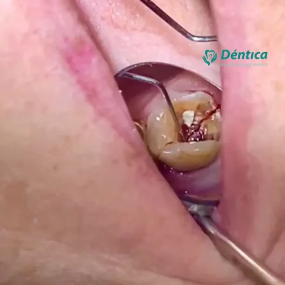 Quando um dente se parte em dois