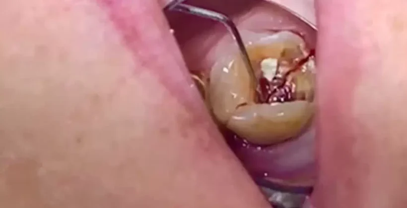 Quando um dente se parte em dois