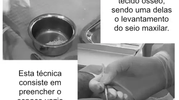 Enxerto ósseo em medicina dentária
