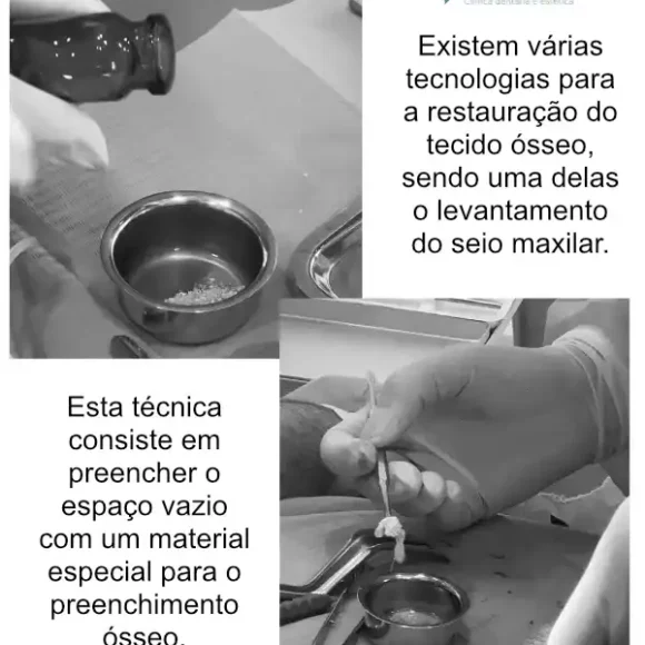 Enxerto ósseo em medicina dentária