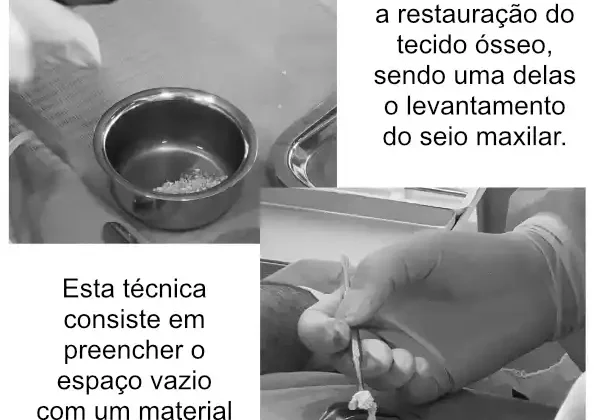 Enxerto ósseo em medicina dentária