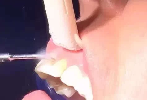 Limpeza ultrassónica dos dentes