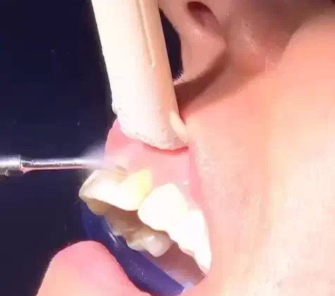 Limpeza ultrassónica dos dentes